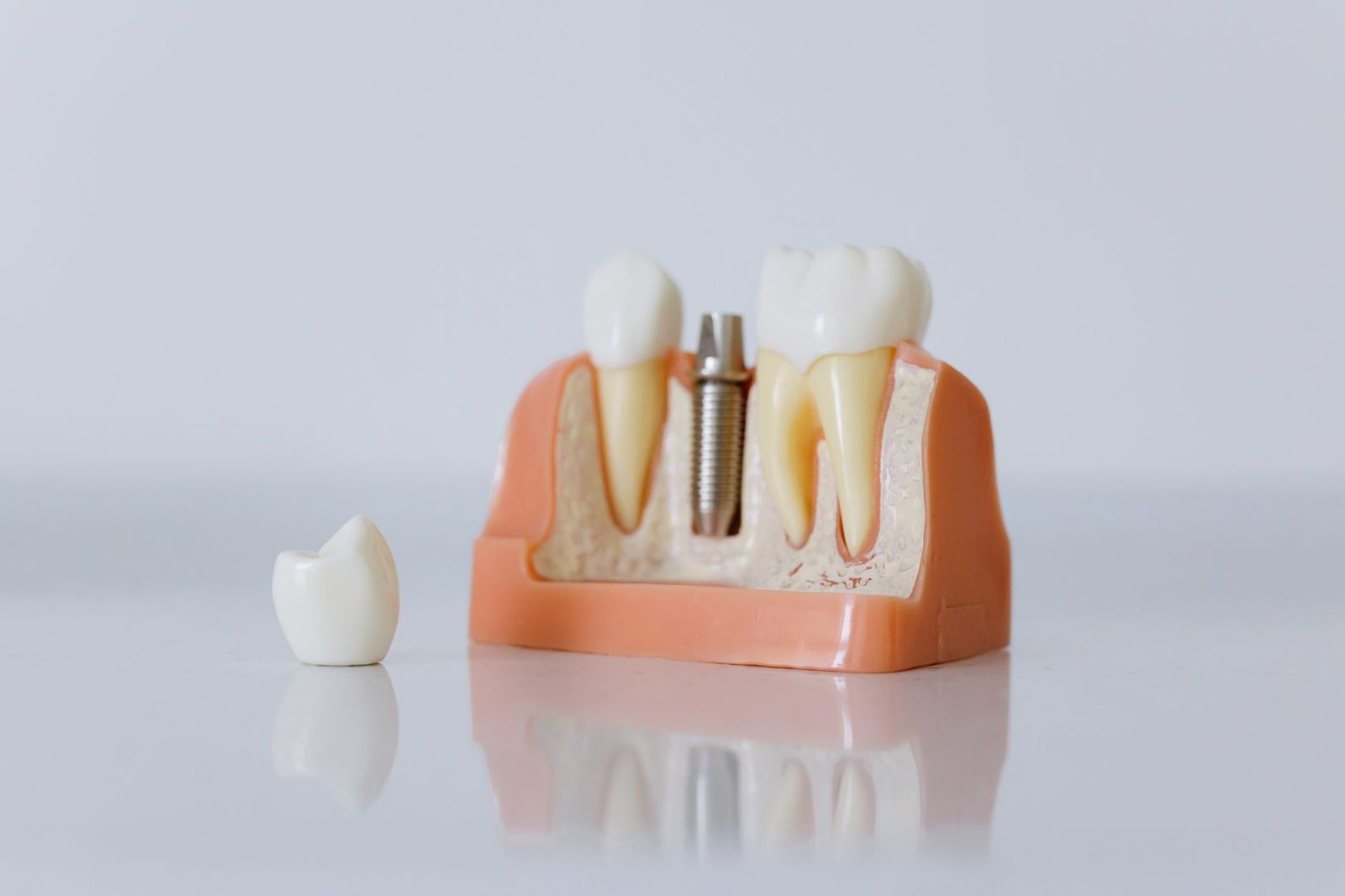 Model of a dental implant beside natural teeth